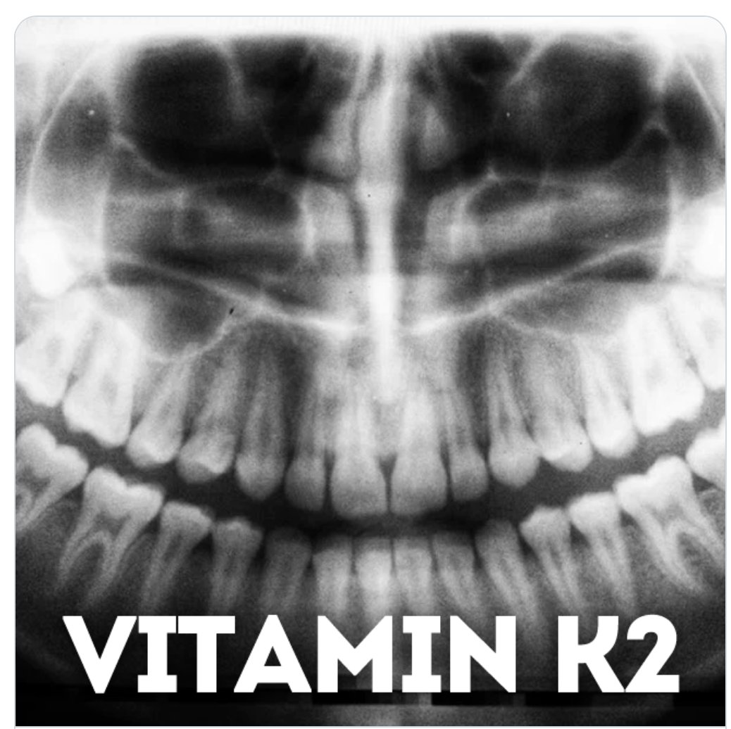 VITAMIN K2 can remineralise your #teeth & activate their #immunesystem. #VitaminK2 can also prevent #toothdecay naturally. It is only found in #animalfoods & certain #fermented dishes. Small amounts are also produced by your #gutbacteria. 
Sources include #meat, #liver & #cheese.