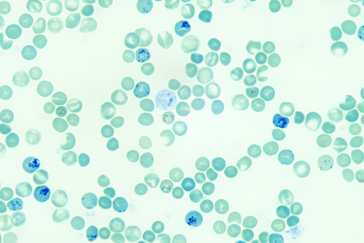 diff_discussion's tweet image. Here we look at a new methylene blue stained smear for reticulocytes and discuss manual retic counts youtu.be/UICXNTv4qx4