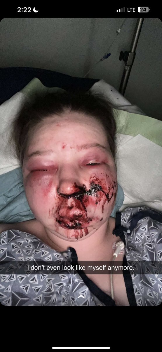 TheAfterHoursXO's tweet photo. I was a victim to a hate crime last night. I thought this girl outside of the bar was my Uber and she acted as if she was then her friends all piled in the car and they proceeded to take me home. When we arrived, they pulled me out of the car and started stomping and punching my https://t.co/nGcKIhFf6N