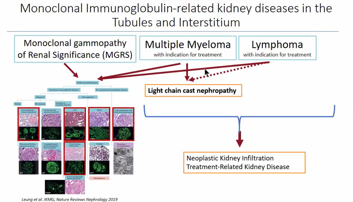 Dr. Virginie Royal gave a beautiful overview of diseases of monoclonal immunoglobulin deposition involving the tubulointerstitum. Here are some pearls: