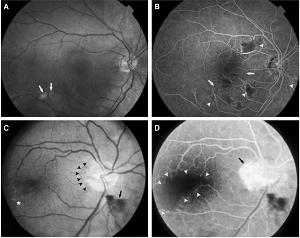 joraltron's tweet photo. 1/🧵Retinal vasculopathy with cerebral leukoencephalopathy and #systemic manifestations (#RVCL-S) is a small-vessel disease that affects highly vascularized tissues including the retina👁️, brain 🧠, liver, and kidneys🫘. Age of onset is often between 35 and 50 years https://t.co/agG6Uw71E1