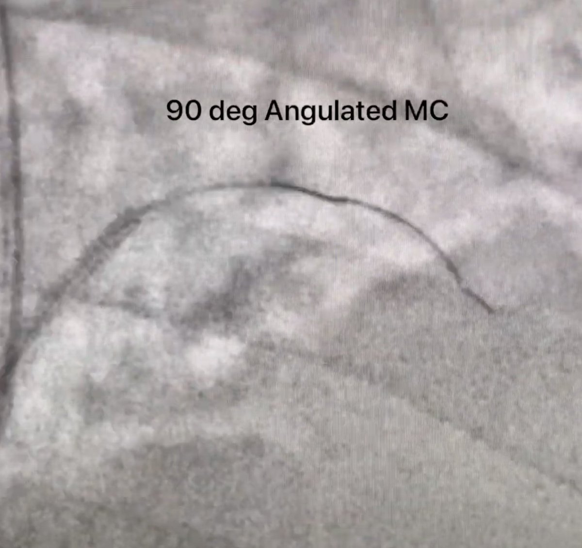 HadyLichaaMD's tweet photo. #CoronaryBifurcationStenting
#ReverseCulotte case: #AngulatedMC use for efficient crossing
https://t.co/q7T4IH8C7S
@FadiGhrairMD, @TWilsonMD, @hadi_khachab7, @MadhuraMyla, @Cathdoctor, @drsalikmemon, @CMosarla, @sorabh_kothari, @fangjonathanx, @farhad_sami2, @heartAPalomo https://t.co/8gd1BB0Cjx