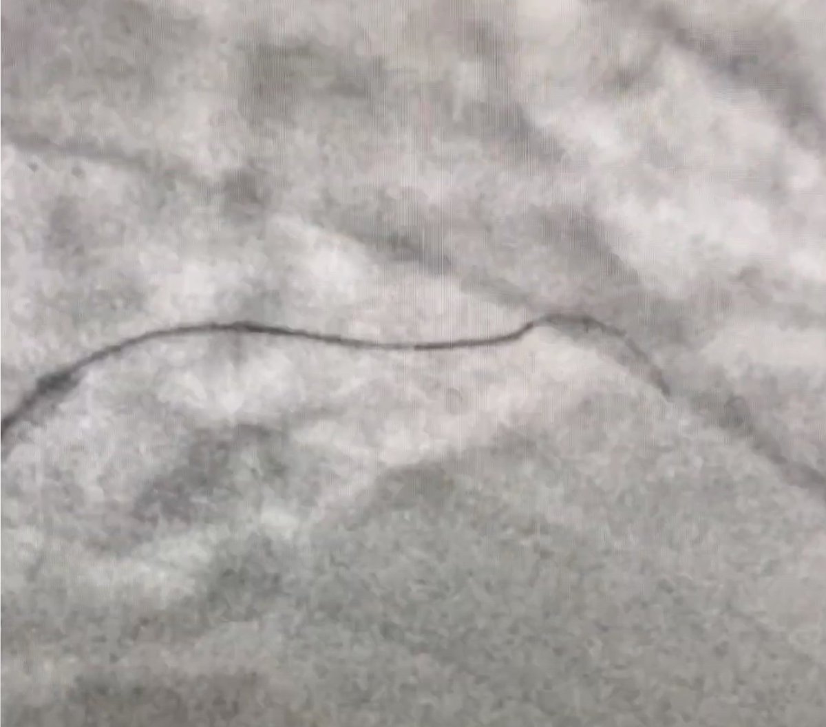 HadyLichaaMD's tweet photo. #CoronaryBifurcationStenting
#ReverseCulotte case: #AngulatedMC use for efficient crossing
https://t.co/q7T4IH8C7S
@FadiGhrairMD, @TWilsonMD, @hadi_khachab7, @MadhuraMyla, @Cathdoctor, @drsalikmemon, @CMosarla, @sorabh_kothari, @fangjonathanx, @farhad_sami2, @heartAPalomo https://t.co/8gd1BB0Cjx