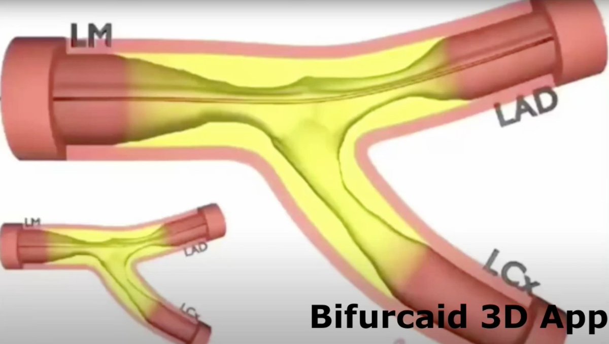 HadyLichaaMD's tweet photo. #CoronaryBifurcationStenting
#ReverseCulotte case: #AngulatedMC use for efficient crossing
https://t.co/q7T4IH8C7S
@FadiGhrairMD, @TWilsonMD, @hadi_khachab7, @MadhuraMyla, @Cathdoctor, @drsalikmemon, @CMosarla, @sorabh_kothari, @fangjonathanx, @farhad_sami2, @heartAPalomo https://t.co/8gd1BB0Cjx