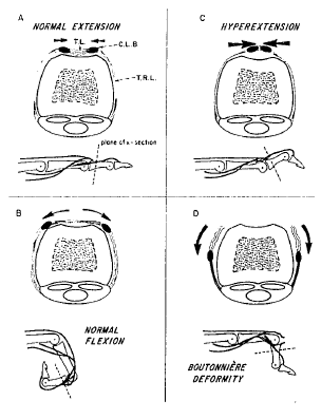 NealChen18's tweet photo. The importance of the balance between the Triangular Ligament and the Transverse Retinacular Ligament, as we learned from Richard Smith, MD. (A, B)

When unbalanced, this may lead to a swan-neck or a boutonniere deformity. (C, D) https://t.co/4RiLYaY6nA