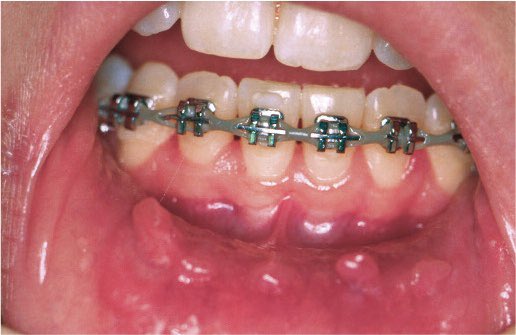 _drirma's tweet photo. Ada yang plan nak buat braces anytime soon? Today, I nak share beberapa kesan sampingan pemakaian braces ⬇️ https://t.co/oGiTaoeGLU