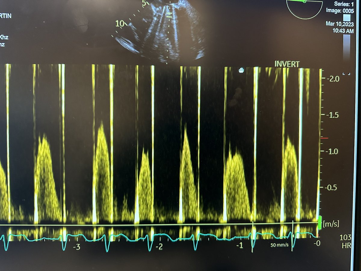 ICPeteB's tweet photo. Thoughts? 50 yo M with hx of afib &amp; s/p On-x MVR 2016, unknown size, admitted with afib RVR and newly depressed LVEF 35%, clean cors, PCWP 30, LVEDP 10. TEE without obvious thrombus/pannus. Mean gradient 7.5, PHT 61, peak E 1.6. HR 110 during TEE. https://t.co/S1pFyfz07k