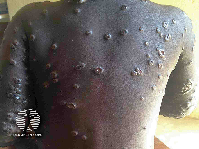 dermnetnz's tweet photo. Weโve recently updated our DermNet page on Mpox to give you the latest information. Check it out on our website > https://t.co/I24vOs6qJz
#DermNet #skincondition #mpox #monkeypox #derm #medicalstudent #medicaleducation #dermatology #healthcare https://t.co/t90weS2kMU
