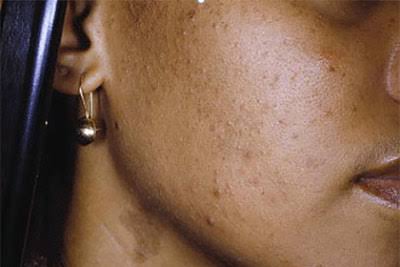 lexiflairbeauty's tweet photo. Acne is a common skin condition that affects millions of people worldwide. Unfortunately, there are many myths and misconceptions about acne that can make it difficult to understand and treat. Let's demystify some of these myths! https://t.co/q7LxSLhQLA