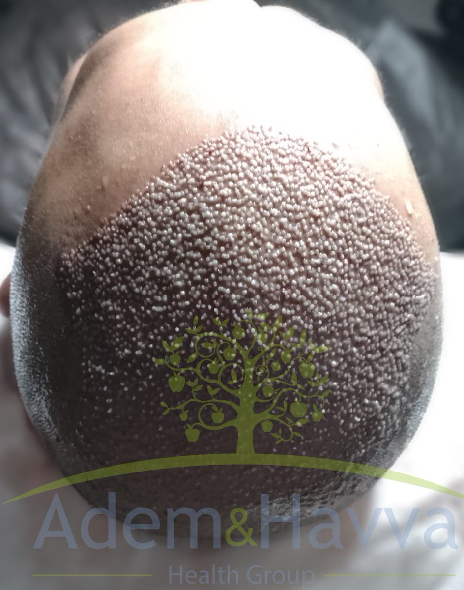 AdemHavvaHealth's tweet photo. Adem &amp; Havva Clinic has been conducted over 20.000 hair transplantation as well as plastic surgeries.
https://t.co/RsONhaxjFb

#HairTransplant #hairtransplantation #hairtransplantinturkey #hairtranplantationfue
#hairtransplantinistanbul #greffedecheveux  #nocuthairtransplant https://t.co/1QC7yUVzg3