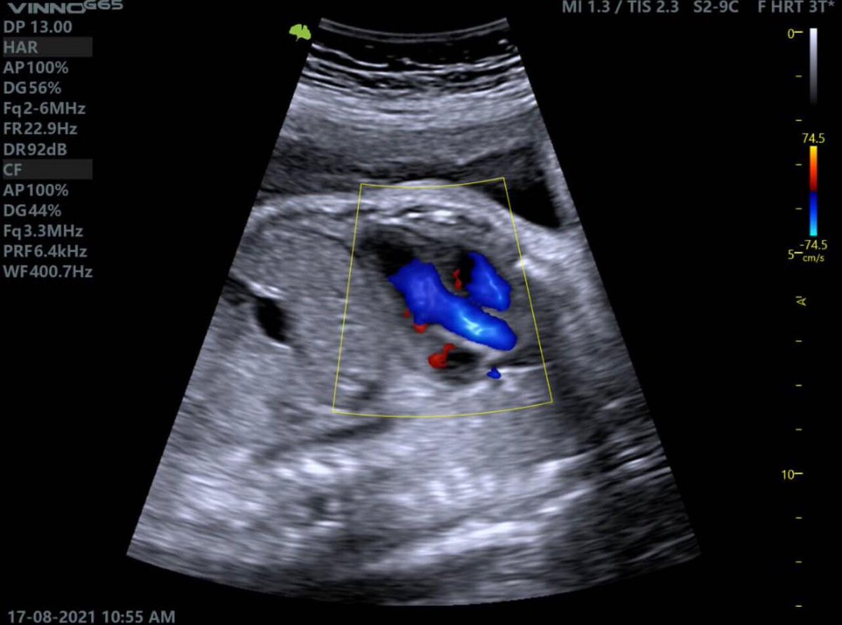 FlashmedSaudi's tweet photo. VINNO G65 … your best choice for fetal imaging
For order and details contact on WhatsApp:
https://t.co/eDyZsKzLx9
#flashmed
#vino
#ultrasound https://t.co/gR2jRgpUDO