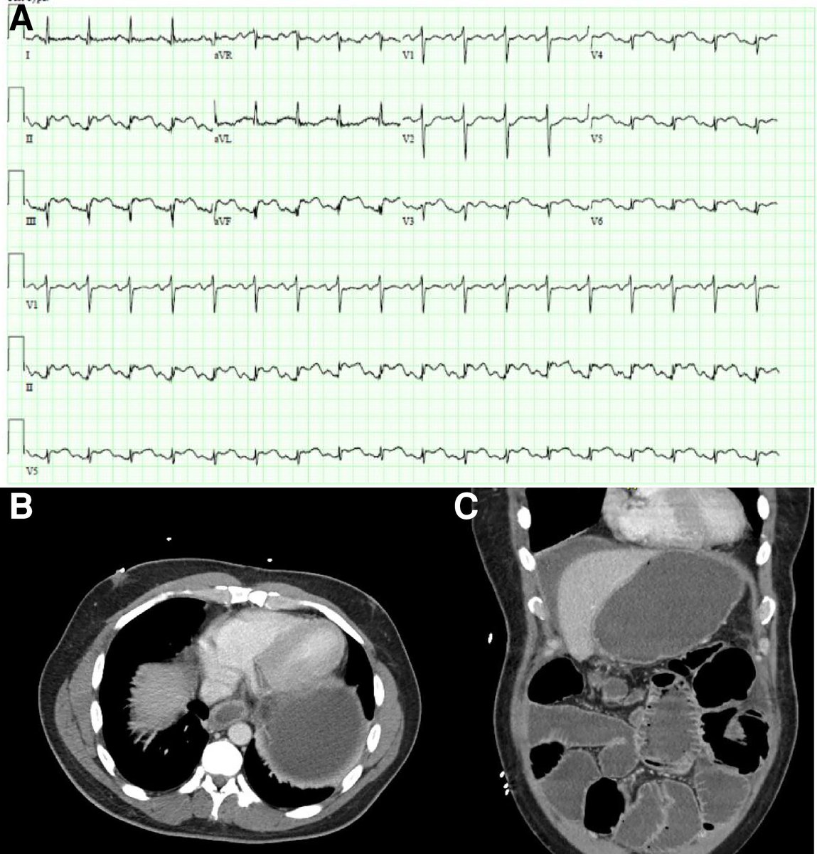 New #SpotTheDiagnosis is out
Check out the case in #EHJACVC 👉doi.org/10.1093/ehjacc…

What caused ECG changes? 👇
1. Acute plaque rupture in mid RCA
2. Viral pericarditis
3. Pericardial irritation from inflammation
4. PE in setting of recent surgery

<a href="/EHJACVCEiC/">EHJACVC Editor-in-Chief</a> <a href="/drmilicaa/">Milica Aleksic</a>