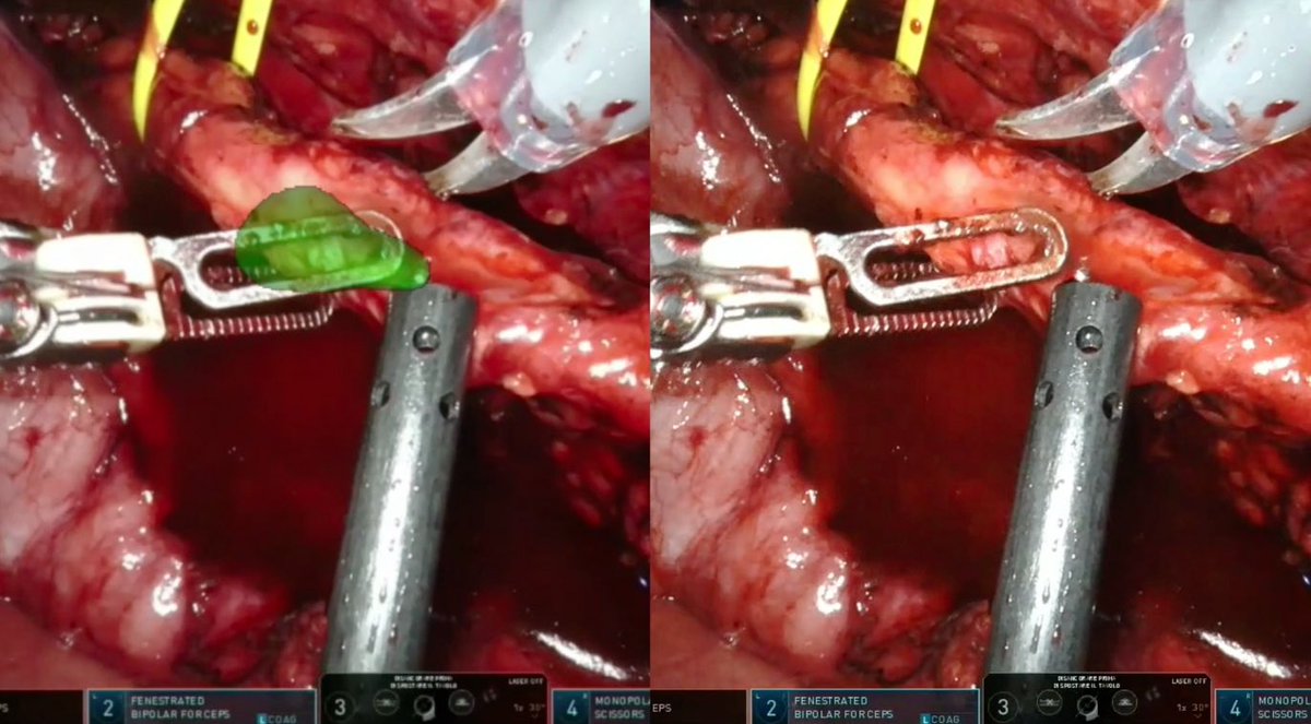 AlbertoPiana2's tweet photo. New application of 3D augmented reality showed at @EAU23: an easier localization of ureteral stricture may potentially avoid intraop ureteroscopy. And then? Buccal mucosa graft for repairing! @PorpigliaF @danieleamparore @EnricoCheccucci @Fede_Piramide @decillis_sa @paoloverri05 https://t.co/gmcfwpMNMq