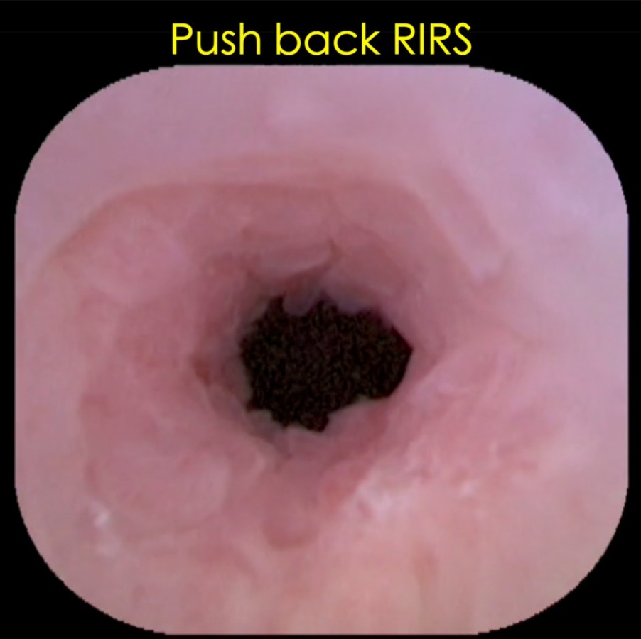 DrVCMohan's tweet photo. Small Impacted Upper #Uretericstone with mucosal edema: Better to avoid Usage of #laser. #Pneumatic or #pushbackRIRS is safer. Sharing a small clip of video
Link Below
https://t.co/FNlqfbpnGi
#upperuretericstone
#avoidlaser https://t.co/wUMMVaemIA