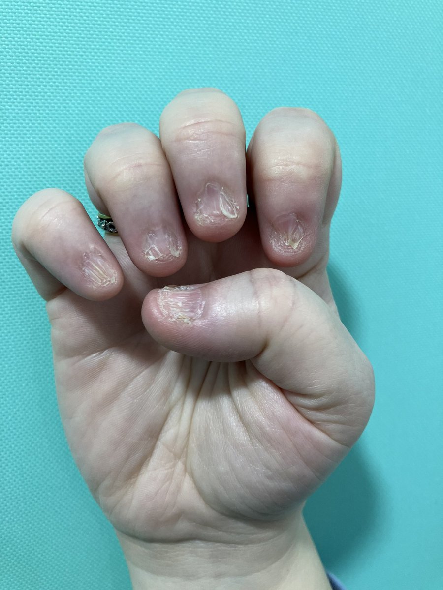 allobe86's tweet photo. Mujer de 58 años que acude con estas lesiones en 🤲🏻 y 🦶🏻🦶🏻.
Refiere también zonas de alopecia en el cuero cabelludo.
#dermatology #dermatología #dermtwitter #dermaworld #2MIR23 #2MIR24 #ENARM2023 #MIR #dermpath #DermaPlus #dermaquiz #dermachallenge #MedTwitter #medicine https://t.co/sPJoUbNDMR