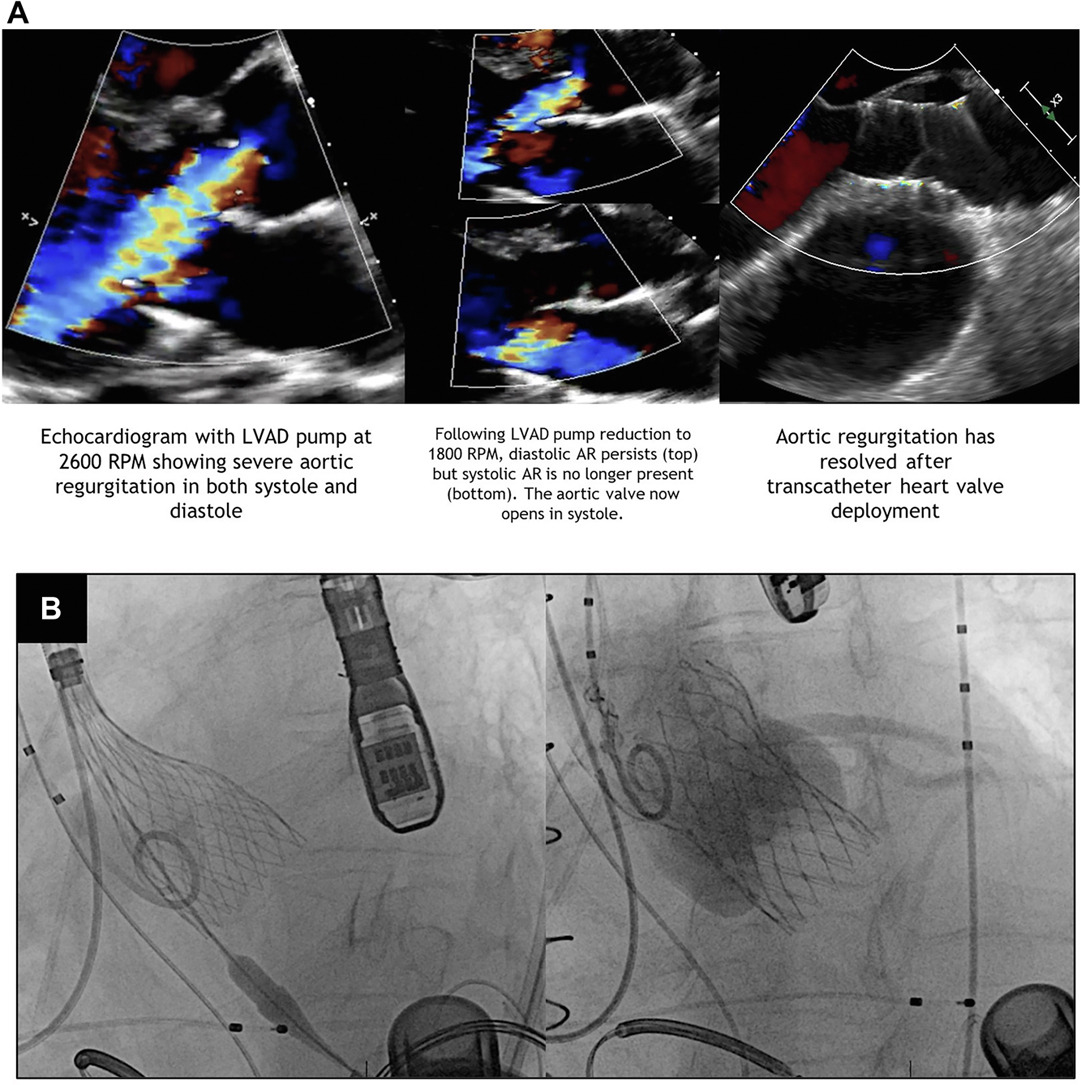 MyJSCAI (@myjscai) on Twitter photo #TAVR for #LVAD-associated AI
<a href="/MartyTamMD/">Marty Tam</a> <a href="/ChetcutiStan/">Stan Chetcuti</a> <a href="/grossman_md/">P Michael Grossman, MD</a> <a href="/MeneesMD/">Daniel Menees</a>
➡️doi.org/10.1016/j.jsca… #TAVR for #LVAD-associated AI
<a href="/MartyTamMD/">Marty Tam</a> <a href="/ChetcutiStan/">Stan Chetcuti</a> <a href="/grossman_md/">P Michael Grossman, MD</a> <a href="/MeneesMD/">Daniel Menees</a>
➡️doi.org/10.1016/j.jsca…