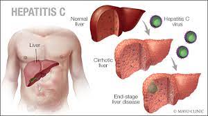 #Viral_hepatitis is an infection that causes #liver_inflammation and damage. Several different viruses cause hepatitis, including #hepatitis A, B, C, D, and E. Visit: scitechnol.com/liver-disease-… Submit research work at: scholarscentral.org/submissions/li…