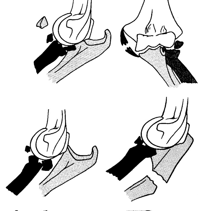 NealChen18's tweet photo. Harrington IJ et al.  Replacement of the radial head in the treatment of unstable elbow fractures. Injury. 1981  PMID: 7263051

An early view of elbow fx dislocations

1. Dislocation + radial head fx
2. MCL/ radial head
3. Coronoid/ radial head
4. Proximal ulna/ radial head https://t.co/j52NJ9HyOe