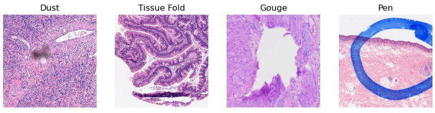 feldstej's tweet image. Objective Quality Control of Digital Pathology Slides using Artificial Intelligence
 Mon, March 13
 225

#USCAP2023 #AI #DigPath 

CNN approach to detect artifacts present in DP slides or detecting images that may not be suitable for downstream computational analysis.