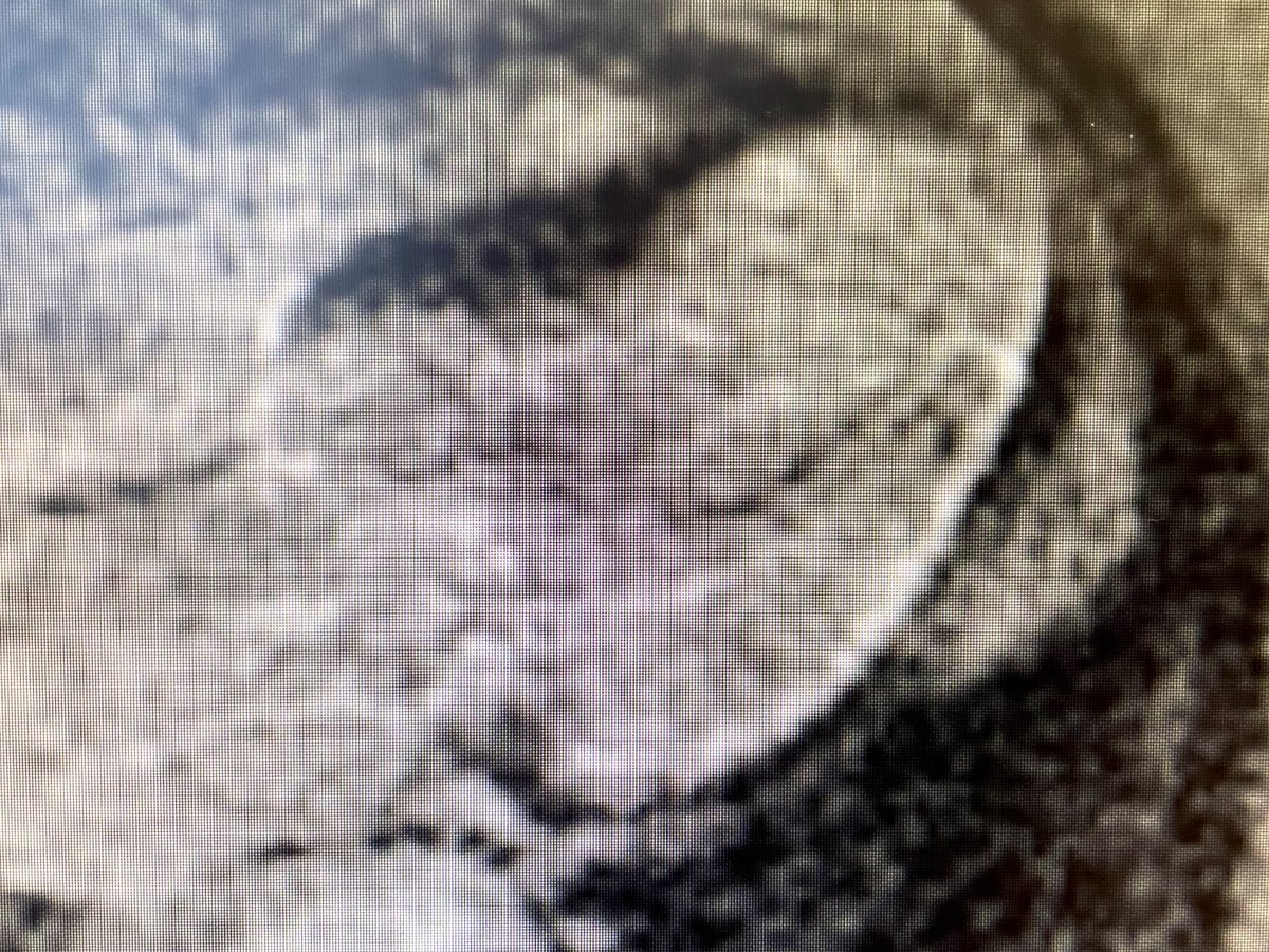 Beatriz j uregui on twitter 52 yo male with surgical
