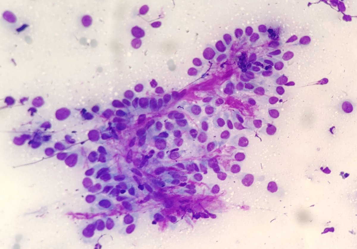 AnupamaArya12's tweet image. 60/M FNAC-Thyroid #cytopath #pathtwitter #thyroid @pepeheffernan @vi_monappa  @DrLakshmirao2 @mathuraiims @nucleololailo @kr_abhisek