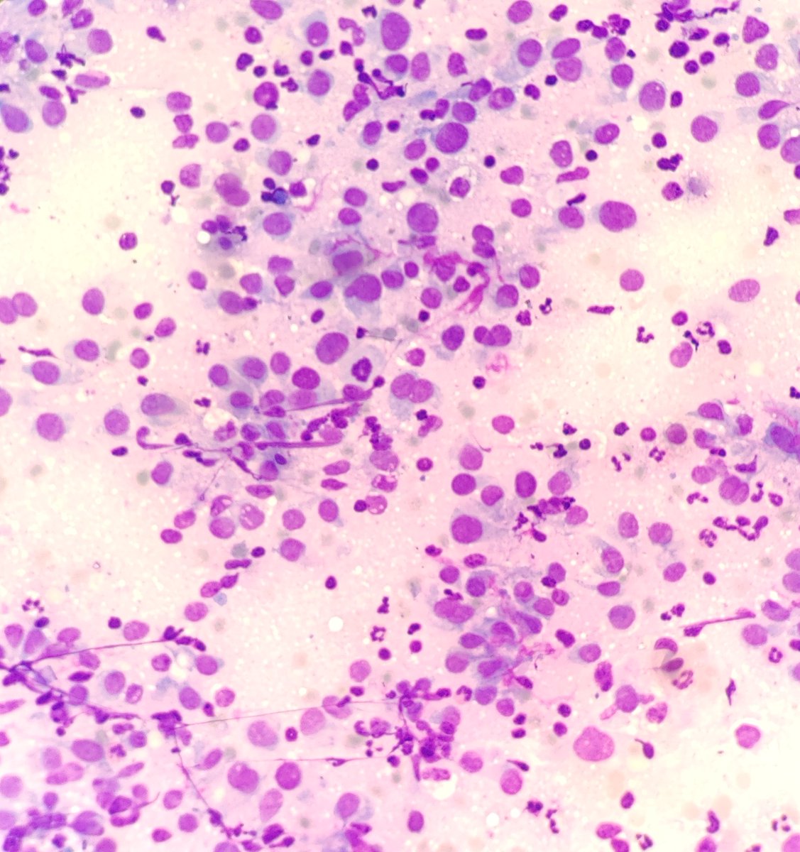 AnupamaArya12's tweet image. 60/M FNAC-Thyroid #cytopath #pathtwitter #thyroid @pepeheffernan @vi_monappa  @DrLakshmirao2 @mathuraiims @nucleololailo @kr_abhisek
