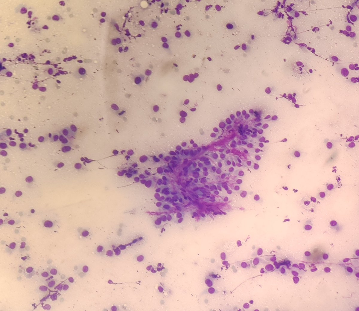 AnupamaArya12's tweet image. 60/M FNAC-Thyroid #cytopath #pathtwitter #thyroid @pepeheffernan @vi_monappa  @DrLakshmirao2 @mathuraiims @nucleololailo @kr_abhisek