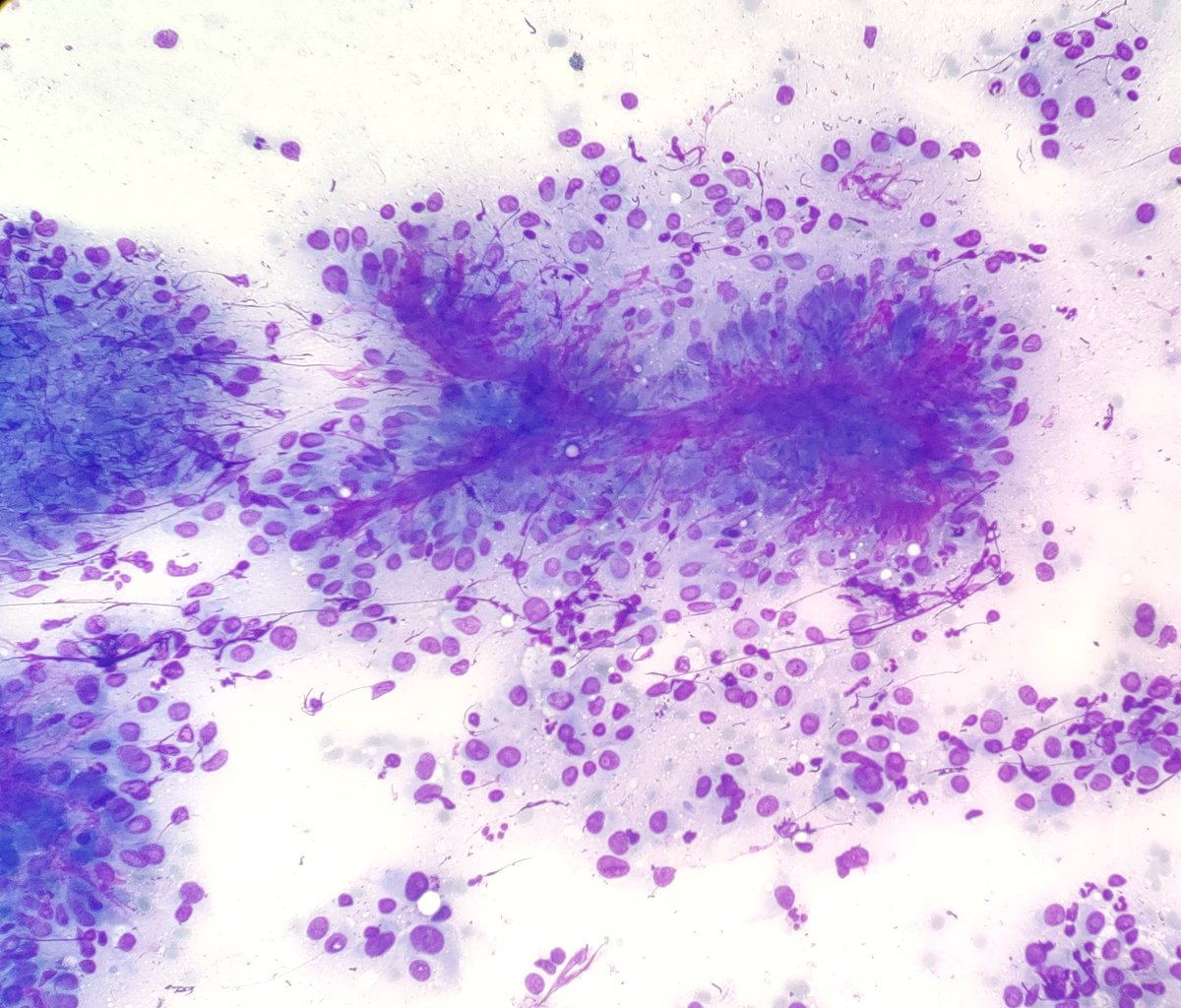 AnupamaArya12's tweet image. 60/M FNAC-Thyroid #cytopath #pathtwitter #thyroid @pepeheffernan @vi_monappa  @DrLakshmirao2 @mathuraiims @nucleololailo @kr_abhisek