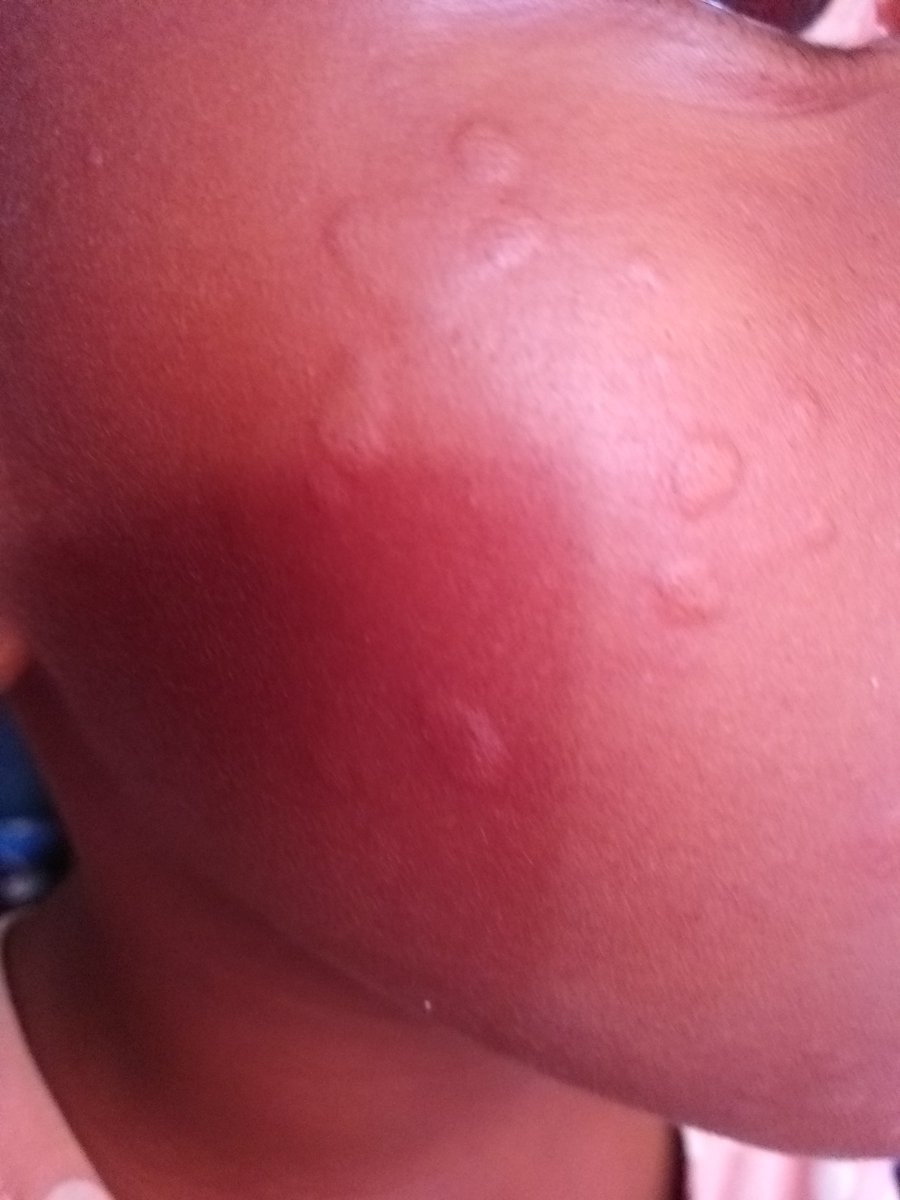 amidi67's tweet photo. Guys

What's this bethuna?

It just appeared on my daughter's skin https://t.co/6cKv4Inheu