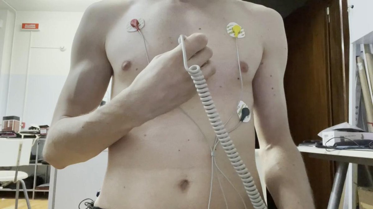 ItalianBoyHB's tweet photo. 100bpm heart beat video with #ekg and #sonoline it has been moved to my new #YouTube channel. Here’s the link https://t.co/R5CINe83Tk - #heartbeat #auscultation #cardiophile #stethoscope https://t.co/U30wDoUV1b