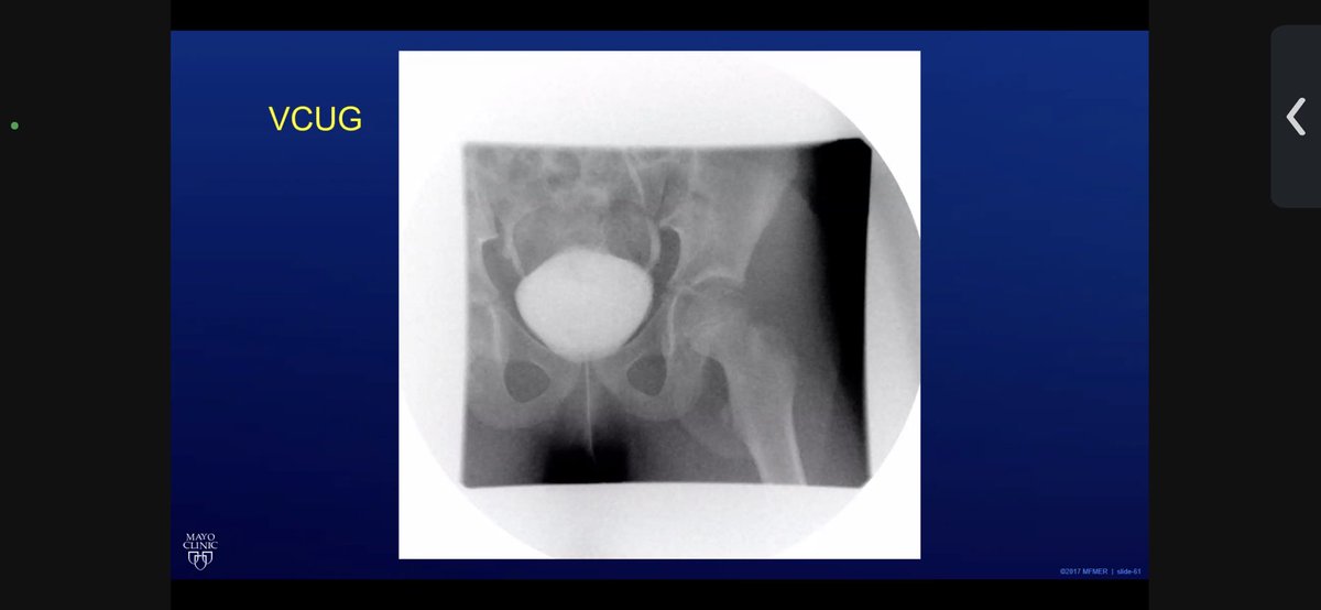 MayoUrology's tweet photo. Today’s #MondayMorningConference question. An 8 yoF p/w 12 culture documented febrile UTIs in the last 18 months. Endorses moderate constipation, but hx others@wise unremarkable. Imaging performed shown below. Question in next thread. @SPU_Urology https://t.co/MtjDf3LuIG