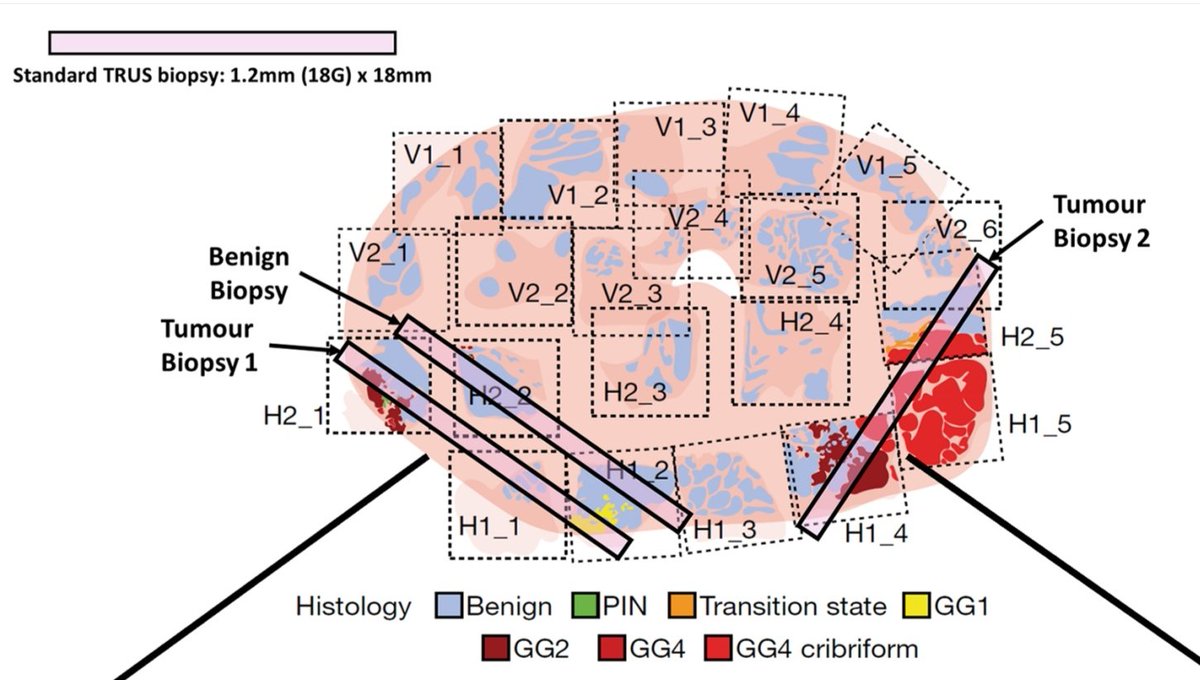 LambAlastair's tweet image. Pleased to share our latest #SpatialTranscriptomics output now on @biorxivpreprint
We show marked variation in gene expr relating to @Decipher_VCYT, #Oncotype_DX & #ProstaDiag genomic scores
Being presented by @Sandy_Figiel this afternoon #EAU23!!
biorxiv.org/content/10.110…