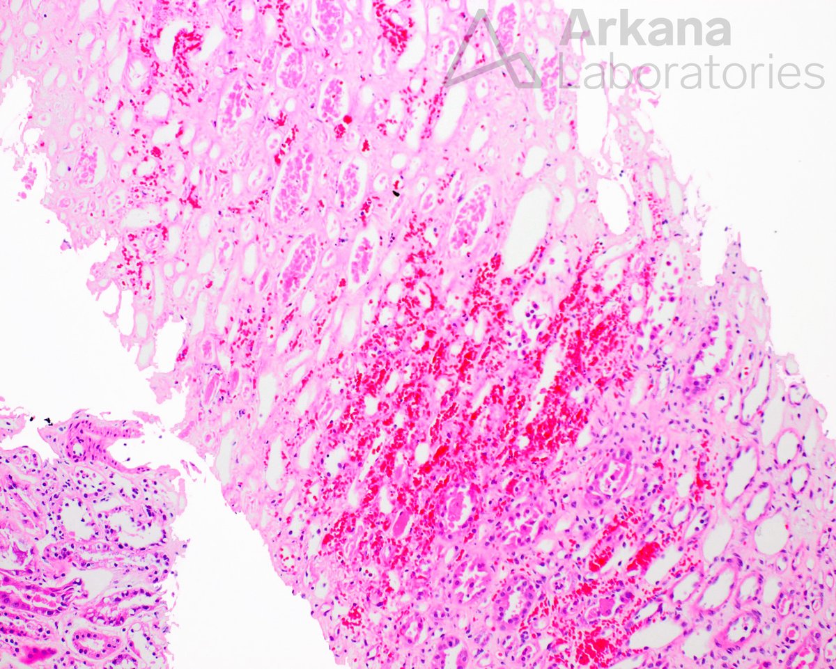 arkanalabs's tweet image. This patient received a kidney transplant 10 days prior and is currently anuric, with delayed graft function. 

What is your diagnosis?

#Nephtwitter #kidneypath