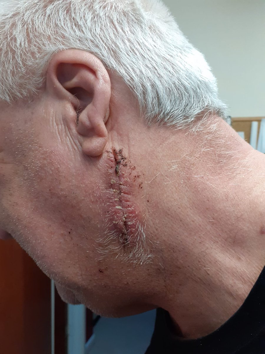 ChrisDerbyshi15's tweet photo. @agricontract 98% today as stitches out and been able to have a bath instead of a shower #usesunscreen https://t.co/oakxqEE9Mj