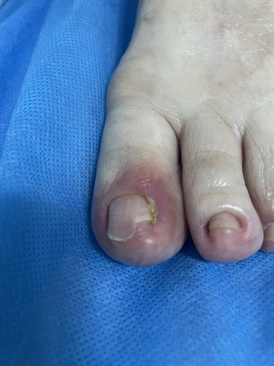 AgeLessBio's tweet photo. 94YO + Brittle Diabetes 
Nail salon injury 💅

No other Tx than Antibiotics ❤️‍🩹 https://t.co/R2D9b5qksl