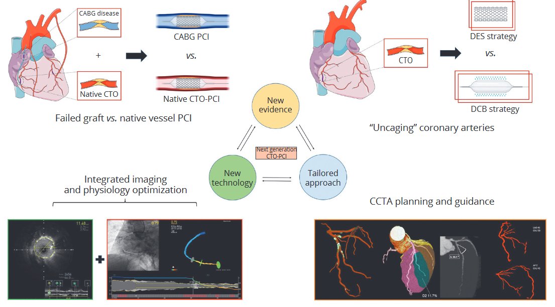 Giuseppe Biondi-Zoccai (@gbiondizoccai) on Twitter photo A glimpse into the future of the percutaneous treatment of coronary chronic total occlusions, by Castaldi et al
minervamedica.it/en/journals/mi…
#MinervaCardiologyAngiology
<a href="/AgostoniPF/">Pierfrancesco Agostoni</a> A glimpse into the future of the percutaneous treatment of coronary chronic total occlusions, by Castaldi et al
minervamedica.it/en/journals/mi…
#MinervaCardiologyAngiology
<a href="/AgostoniPF/">Pierfrancesco Agostoni</a>
