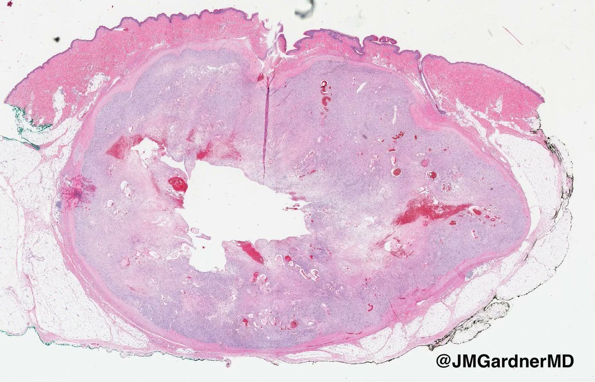JMGardnerMD's tweet image. "Cyst" on the trunk of an adult. Your diagnosis? (Hint: it's not a cyst!) 
Answer: kikoxp.com/posts/8892
Video: kikoxp.com/posts/4093
#pathology #pathologists #pathTwitter #dermpath #dermatology #dermatologia #dermtwitter #BSTpath
