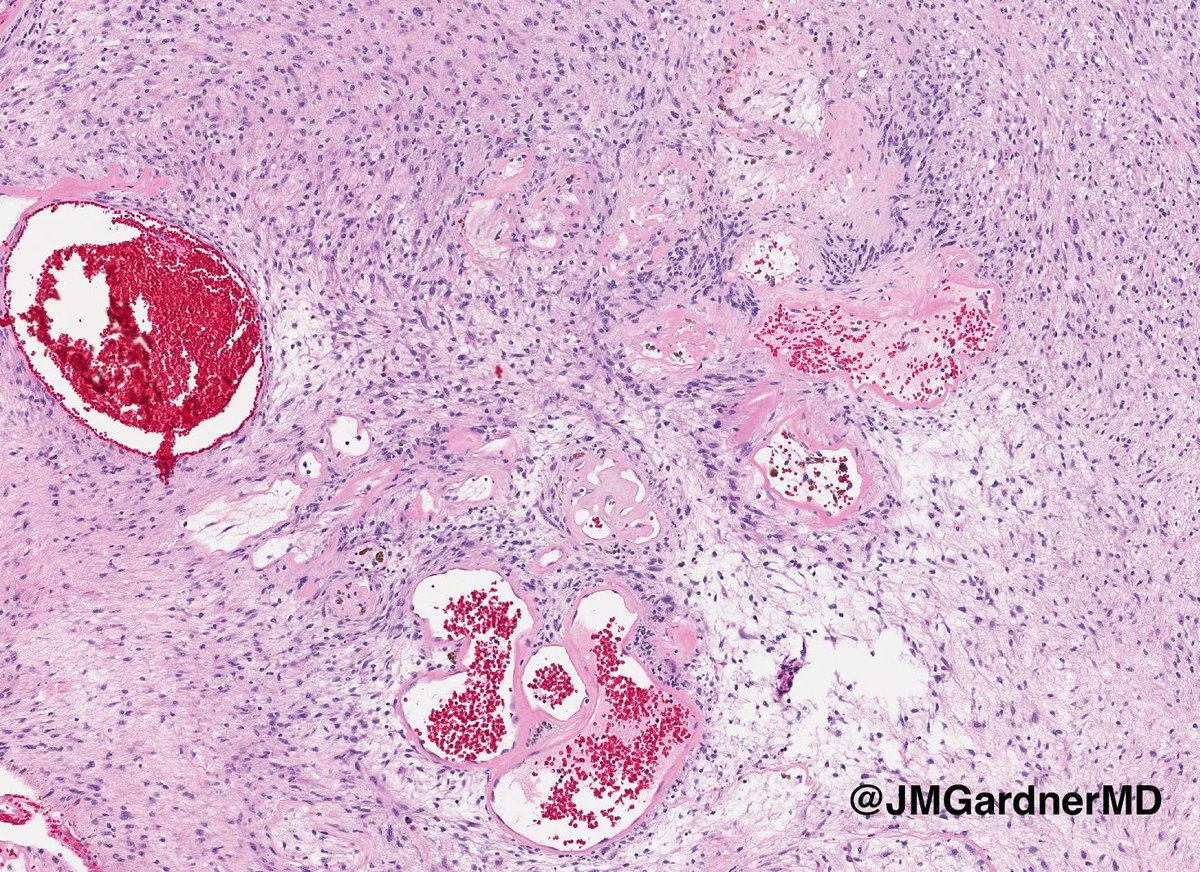 JMGardnerMD's tweet image. "Cyst" on the trunk of an adult. Your diagnosis? (Hint: it's not a cyst!) 
Answer: kikoxp.com/posts/8892
Video: kikoxp.com/posts/4093
#pathology #pathologists #pathTwitter #dermpath #dermatology #dermatologia #dermtwitter #BSTpath