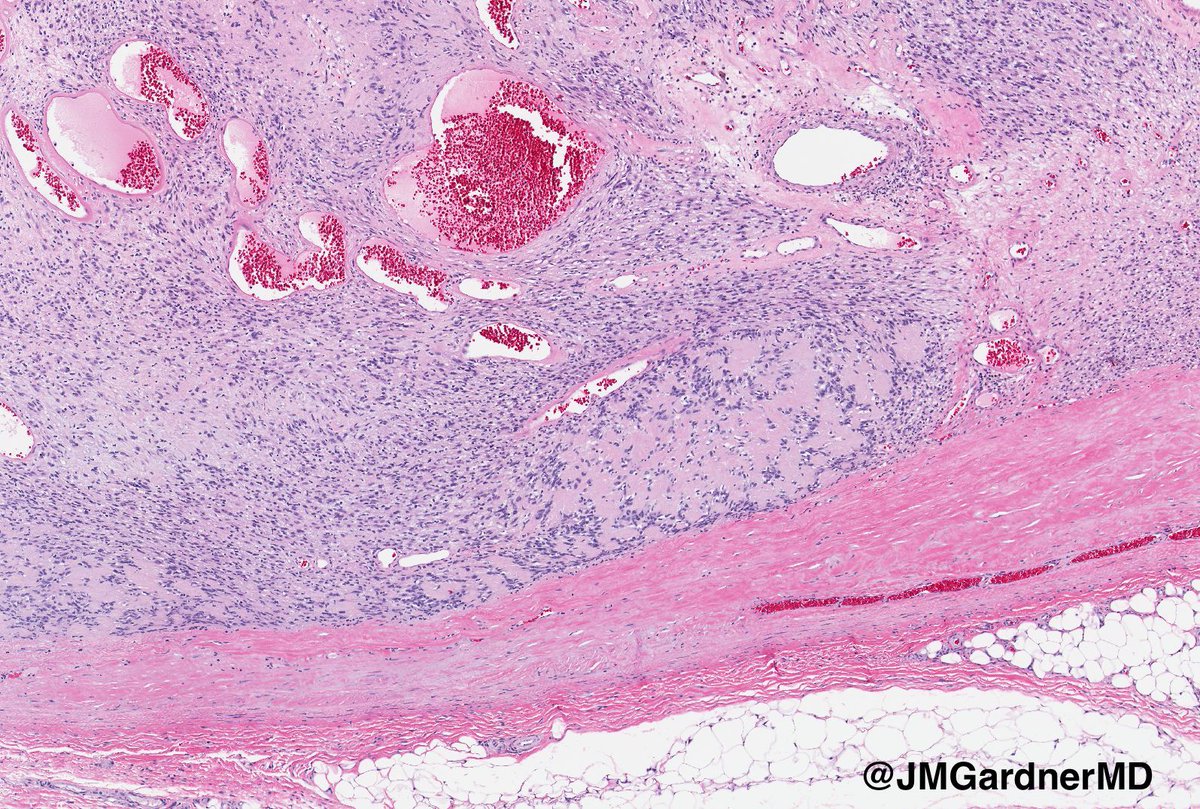 JMGardnerMD's tweet image. "Cyst" on the trunk of an adult. Your diagnosis? (Hint: it's not a cyst!) 
Answer: kikoxp.com/posts/8892
Video: kikoxp.com/posts/4093
#pathology #pathologists #pathTwitter #dermpath #dermatology #dermatologia #dermtwitter #BSTpath