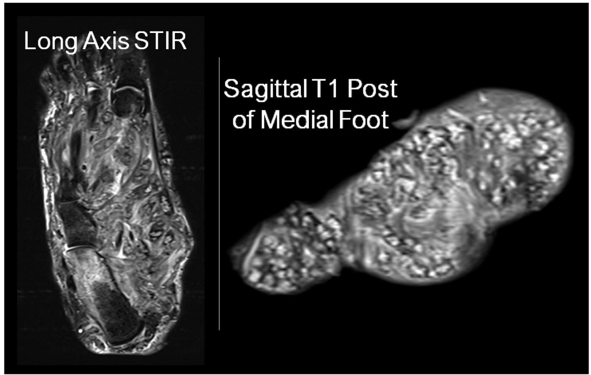 Society of Skeletal Radiology (@ssrbone) on Twitter photo Case of the Day (COD) #4 at #SSR2023, presented by Dr. Michael Brown of Northwell Radiology <a href="/NorthwellRad/">Northwell Imaging</a>. Answer to follow.
#SSRBONE23COD Case of the Day (COD) #4 at #SSR2023, presented by Dr. Michael Brown of Northwell Radiology <a href="/NorthwellRad/">Northwell Imaging</a>. Answer to follow.
#SSRBONE23COD