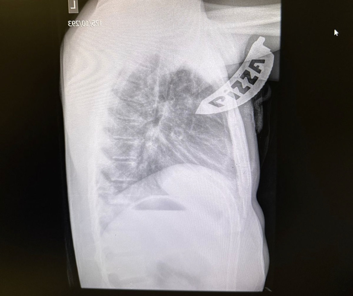 Another retained blade. CT embedded in lung but no major vascular injury. Removed in theatre without a Thoracotomy.