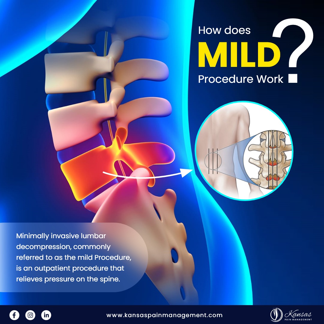 KansasPain's tweet photo. Mild procedure is a minimally invasive procedure used to treat chronic lower back pain caused by lumbar spinal stenosis, a condition in which the spinal canal narrows and compresses the spinal nerves.
#kansaspainmanagement #mildprocedure #lumbarspinalstenosis #painrelief https://t.co/nW87hXPk2R