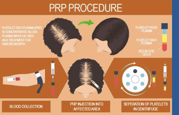 PRP or plasma injections 👦🏻👩Male or Female 👍Increase the blood flow to your scalp 👍Effectively treating thinning hair 💉Medical Experts only £200 ⏰90 mins 07884004603 #ScottishBorders #Edinburgh #ThinningHair #Balding #PRP #Alopecia #Galashiels #Jedburgh #Kelso #Melrose