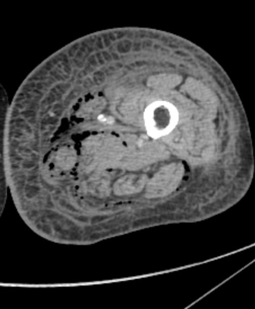 Baez1Adan's tweet photo. 50 YO M, P complaint: fever,left leg severe pain,local edema and erythema. CT: Gas within fluid collections tracking along fascial planes, specific finding but not always present: Necrotizing fasciitis. S. Avium. @MskSerme @SermeMsk #Radres #FOAMrad #Orthobullets #Radiology #MSK https://t.co/w4xuTvA3YP