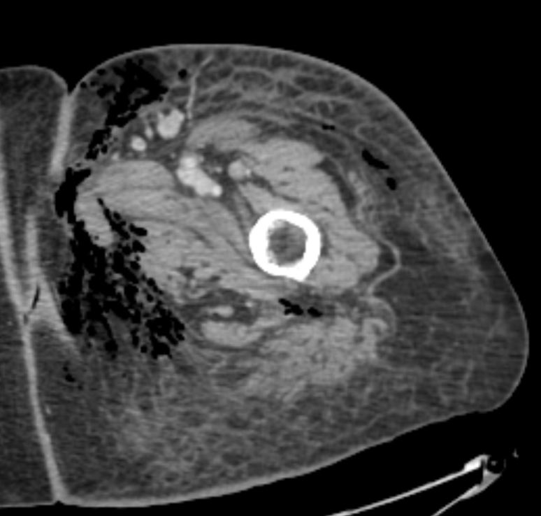 Baez1Adan's tweet photo. 50 YO M, P complaint: fever,left leg severe pain,local edema and erythema. CT: Gas within fluid collections tracking along fascial planes, specific finding but not always present: Necrotizing fasciitis. S. Avium. @MskSerme @SermeMsk #Radres #FOAMrad #Orthobullets #Radiology #MSK https://t.co/w4xuTvA3YP