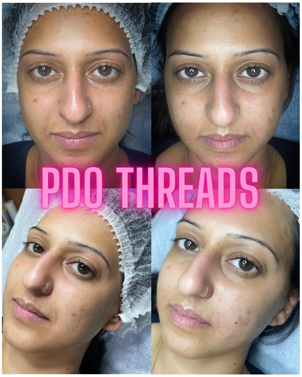 yasinjectmern's tweet image. PDO Threads Along The Midface Can Lift the Face giving you a more Youthful Appearance!

Have You Thought About Getting Threads?  

Call US TODAY and we will answer any questions you may have! 914.343.3247

#threadlifting #fillertreatment #pdoliftingthreads #pdofoxeyes #threadli