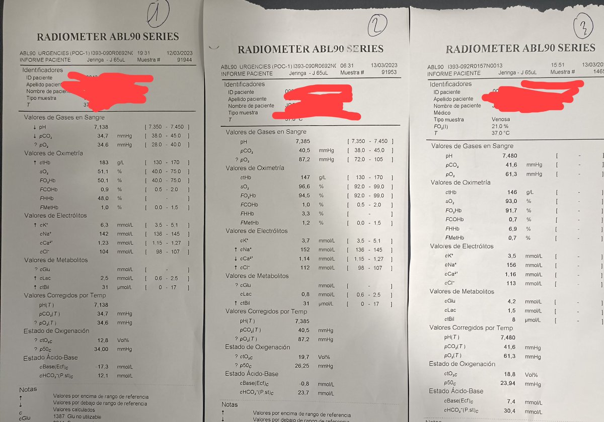 Remember: inappropriate Sodium Bicarbonate treatment in DKA leads to HiperNa and metabolic alkalosis.