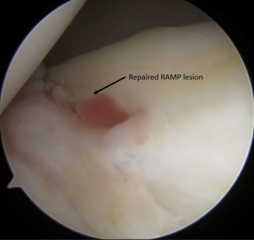 Be a CHAMP, don’t miss the RAMP! 

Medial meniscus RAMP lesions are tears at the peripheral capsular attachment that are often missed. They are commonly associated with ACL ruptures. For this patient we went with an all-inside technique to close the gap and facilitate healing.