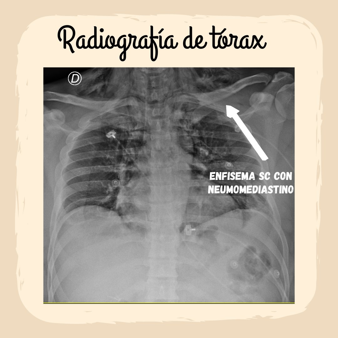 CEA_HIBA's tweet photo. Caso del día de hoy! 🔥👨‍🦰🏋️‍♀️#MedEd #MedTwitter https://t.co/PPFxQh6Sc1