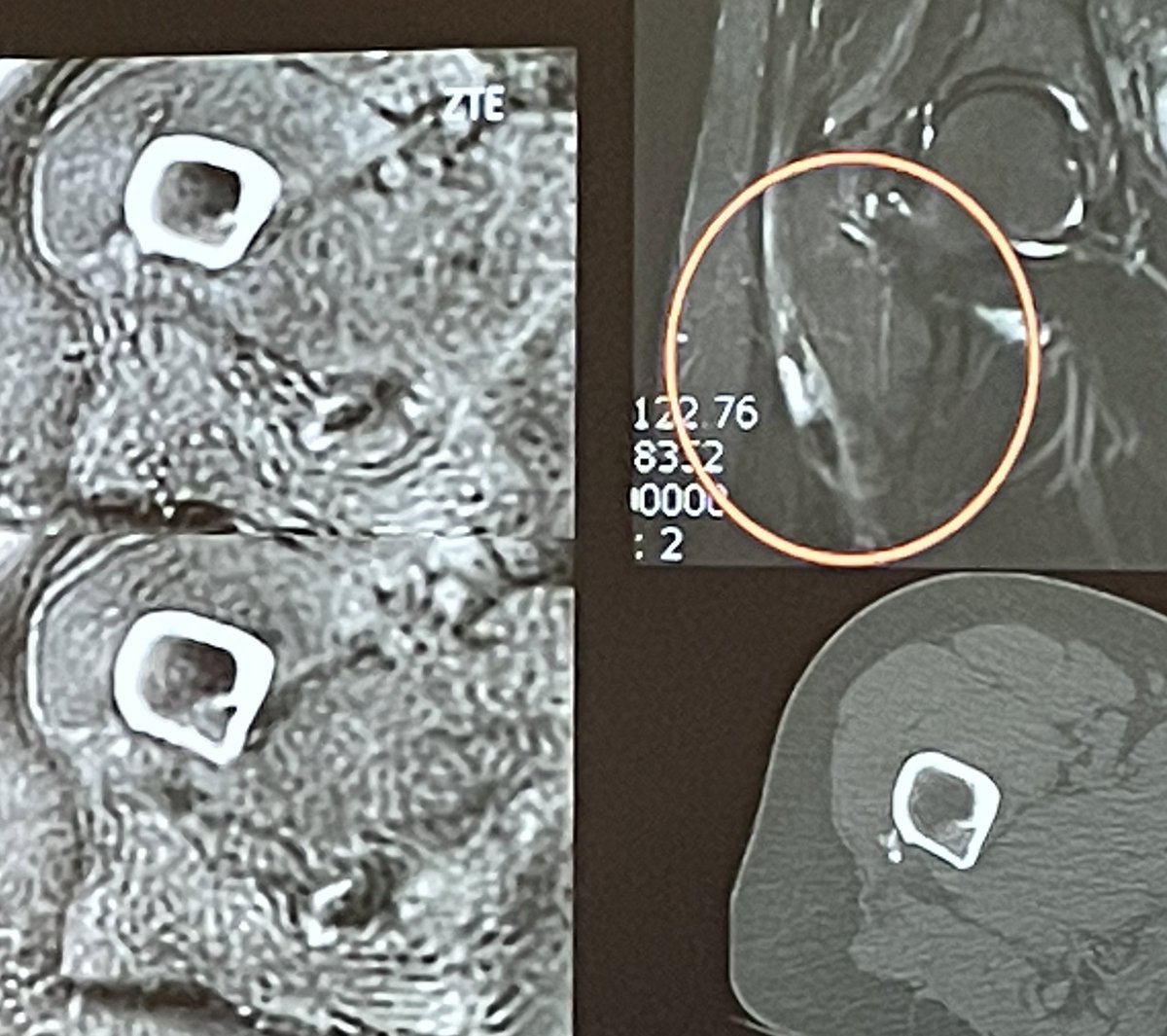 MRI ZTE (Zero TE) sequence is a CT-like image &amp; improves the diagnosis in certain situations without adding a CT :

- Lumbar pain of adolescents 
      -> isthmic lysis

- Joint in the context of a trauma 
      -> fracture

- Extensive unexplained edema 
      -> calcification